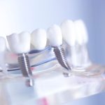 İmplant Fiyatları 2024 (2)