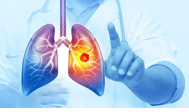 her-yil-25-bin-akciger-kanseri-vakasi-onlenebilir.jpg